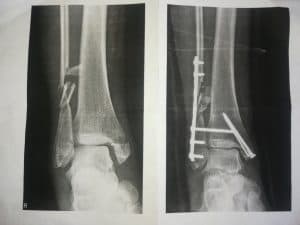 Röntgenfoto's van voor en na de operatie